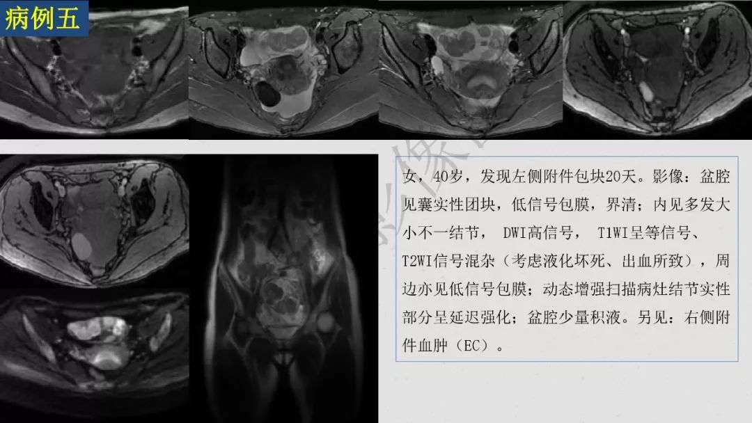 【PPT】卵巢透明细胞癌影像诊断