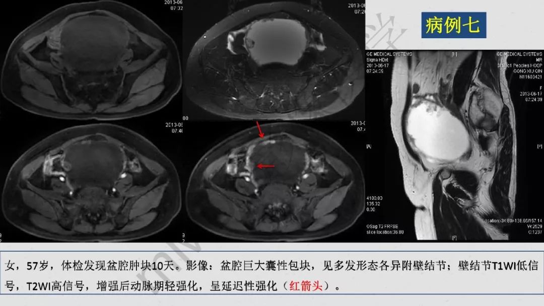 【PPT】卵巢透明细胞癌影像诊断