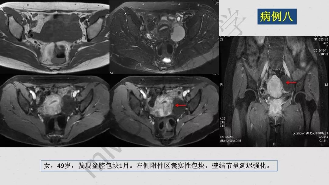 【PPT】卵巢透明细胞癌影像诊断