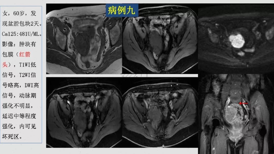 【PPT】卵巢透明细胞癌影像诊断