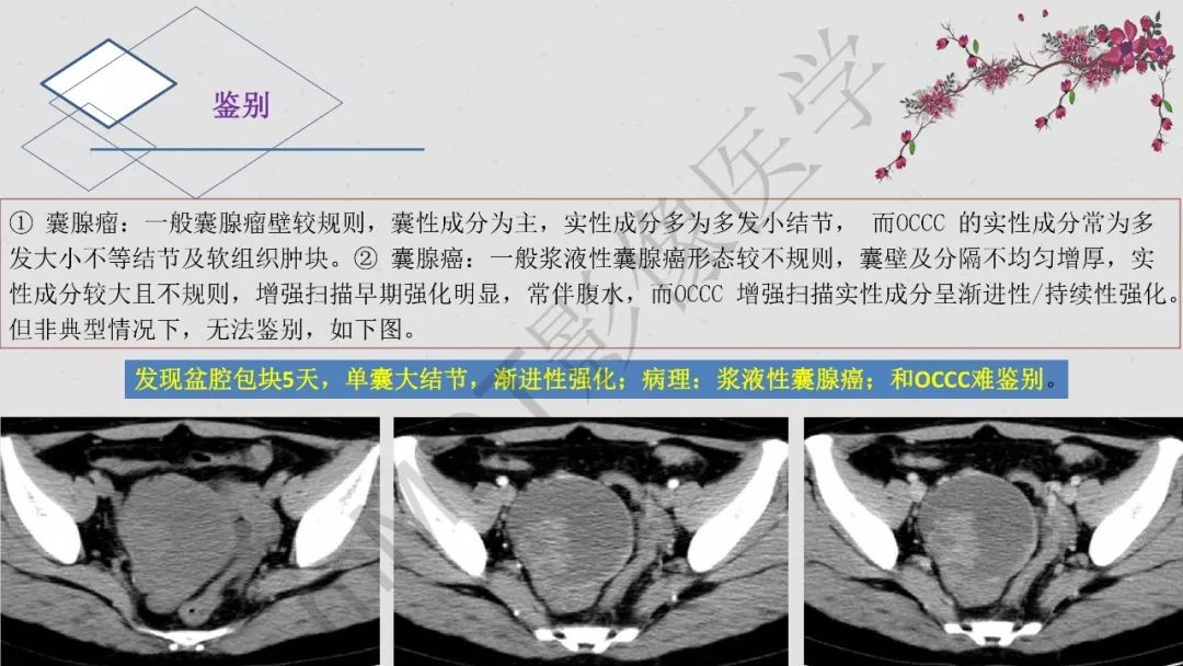 【PPT】卵巢透明细胞癌影像诊断