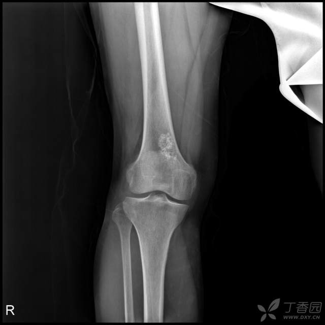 【病例】股骨下段髓腔内的“爆米花”是啥? 【病例】股骨下段髓腔内的“爆米花”是啥?
