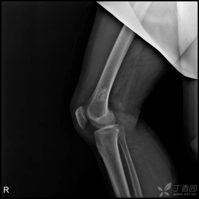 【病例】股骨下段髓腔内的“爆米花”是啥? 【病例】股骨下段髓腔内的“爆米花”是啥?