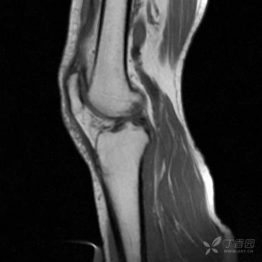 【病例】股骨下段髓腔内的“爆米花”是啥? 【病例】股骨下段髓腔内的“爆米花”是啥?