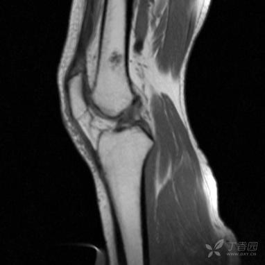 【病例】股骨下段髓腔内的“爆米花”是啥? 【病例】股骨下段髓腔内的“爆米花”是啥?