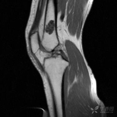 【病例】股骨下段髓腔内的“爆米花”是啥? 【病例】股骨下段髓腔内的“爆米花”是啥?