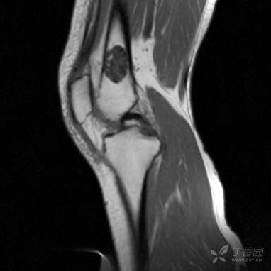 【病例】股骨下段髓腔内的“爆米花”是啥? 【病例】股骨下段髓腔内的“爆米花”是啥?