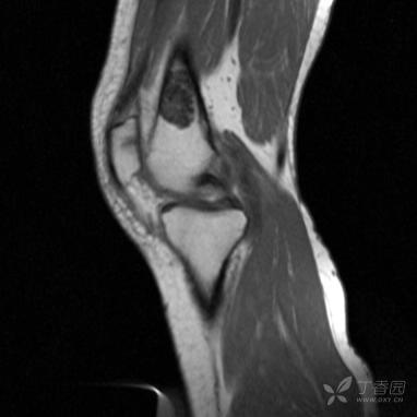 【病例】股骨下段髓腔内的“爆米花”是啥? 【病例】股骨下段髓腔内的“爆米花”是啥?