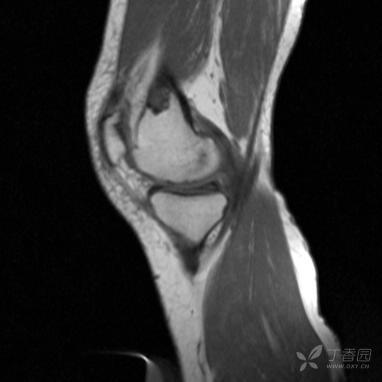 【病例】股骨下段髓腔内的“爆米花”是啥? 【病例】股骨下段髓腔内的“爆米花”是啥?