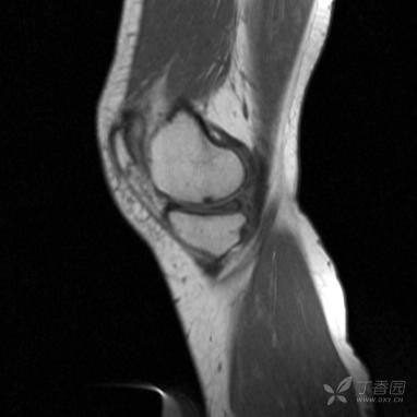 【病例】股骨下段髓腔内的“爆米花”是啥? 【病例】股骨下段髓腔内的“爆米花”是啥?