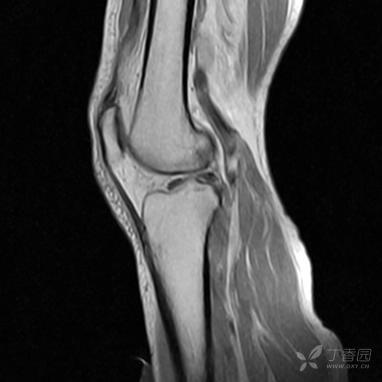 【病例】股骨下段髓腔内的“爆米花”是啥? 【病例】股骨下段髓腔内的“爆米花”是啥?
