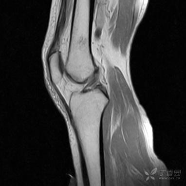 【病例】股骨下段髓腔内的“爆米花”是啥? 【病例】股骨下段髓腔内的“爆米花”是啥?