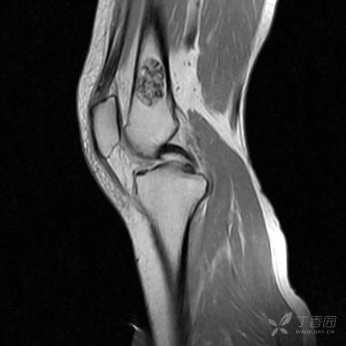 【病例】股骨下段髓腔内的“爆米花”是啥? 【病例】股骨下段髓腔内的“爆米花”是啥?