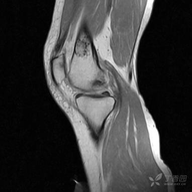 【病例】股骨下段髓腔内的“爆米花”是啥? 【病例】股骨下段髓腔内的“爆米花”是啥?