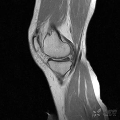 【病例】股骨下段髓腔内的“爆米花”是啥? 【病例】股骨下段髓腔内的“爆米花”是啥?