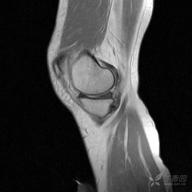 【病例】股骨下段髓腔内的“爆米花”是啥? 【病例】股骨下段髓腔内的“爆米花”是啥?