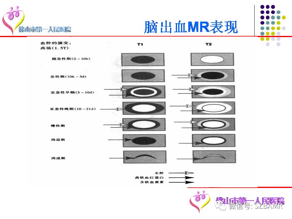 【PPT】脑出血MR表现及病因分析
