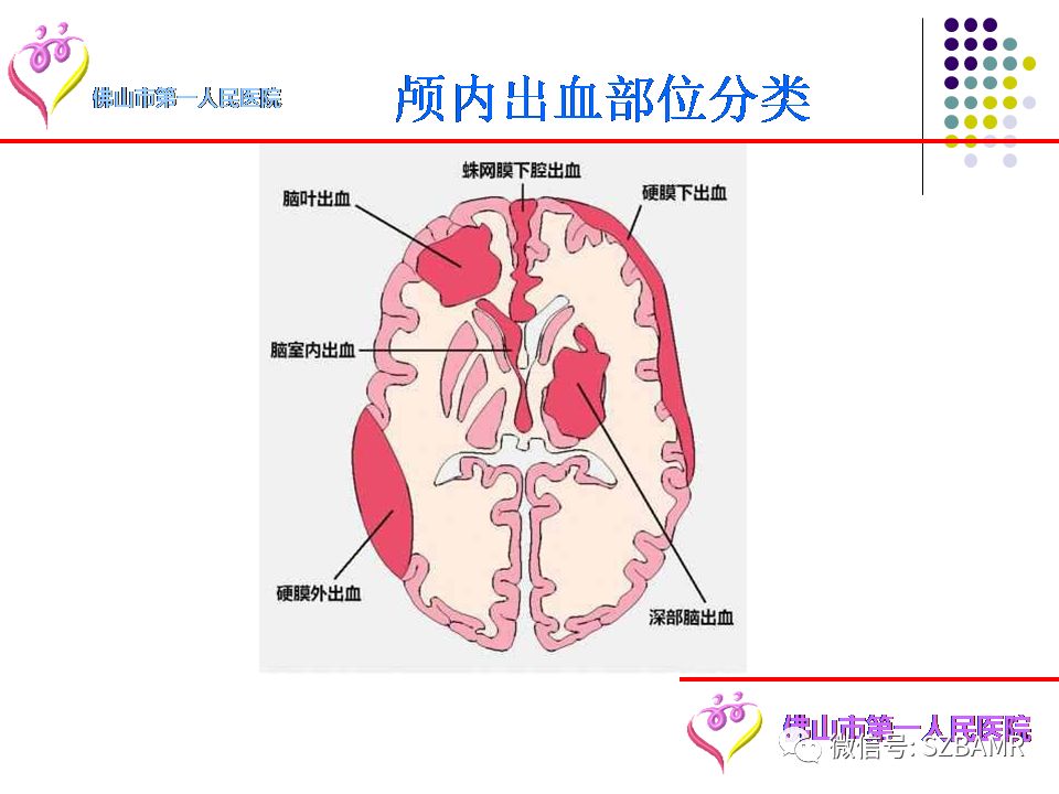 【PPT】脑出血MR表现及病因分析