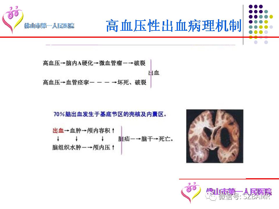 【PPT】脑出血MR表现及病因分析