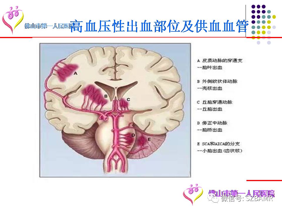 【PPT】脑出血MR表现及病因分析