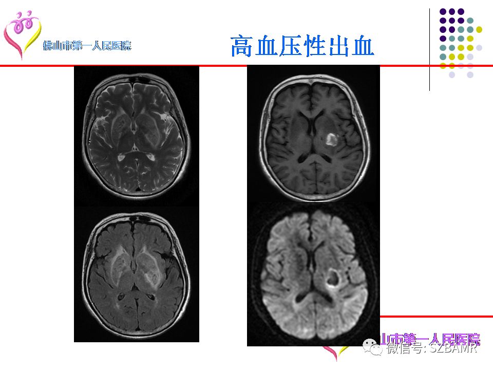 【PPT】脑出血MR表现及病因分析