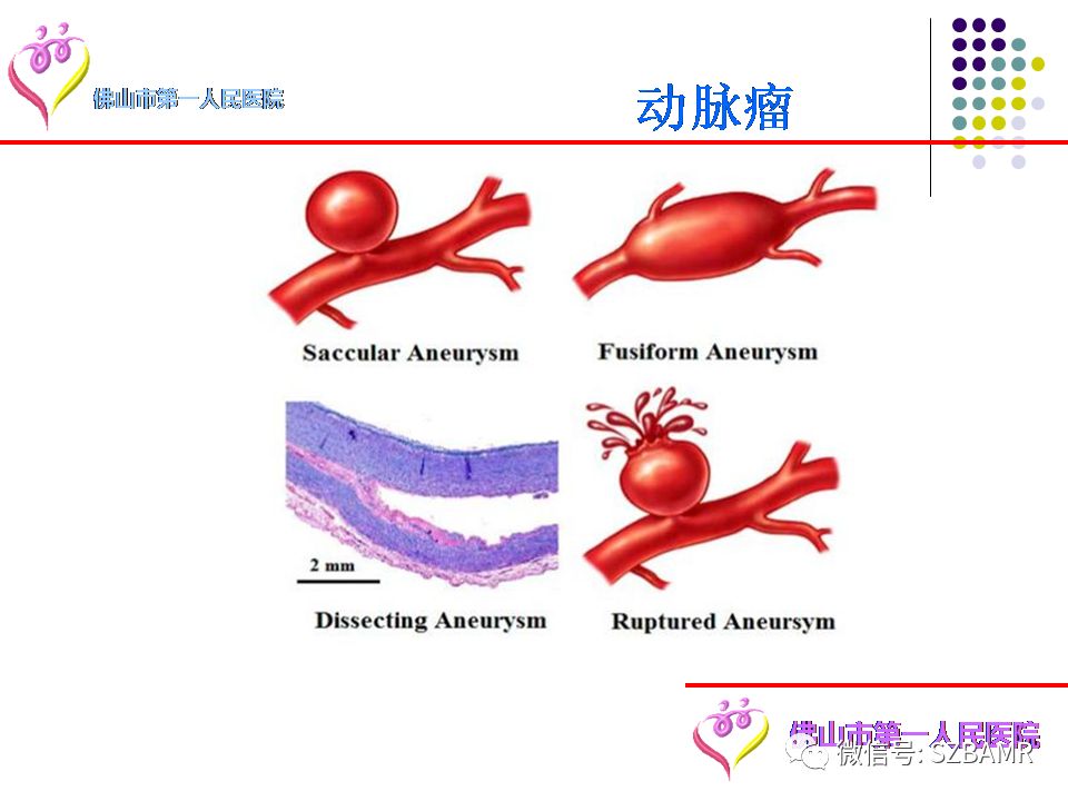 【PPT】脑出血MR表现及病因分析