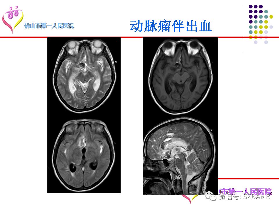 【PPT】脑出血MR表现及病因分析