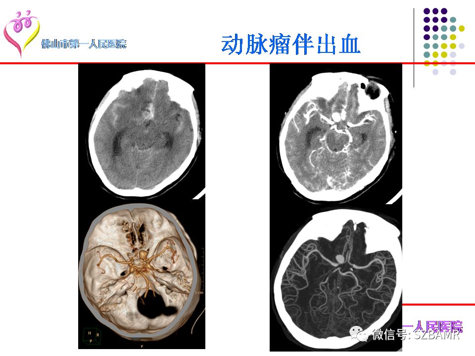 【PPT】脑出血MR表现及病因分析