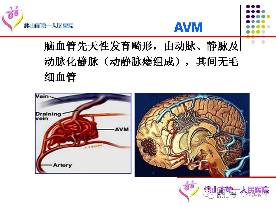 【PPT】脑出血MR表现及病因分析