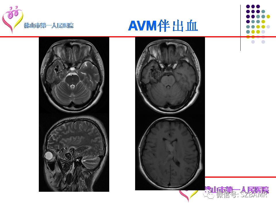 【PPT】脑出血MR表现及病因分析