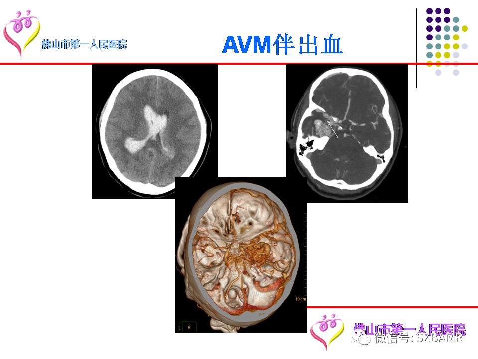 【PPT】脑出血MR表现及病因分析