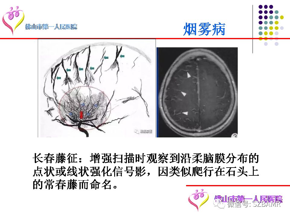 【PPT】脑出血MR表现及病因分析