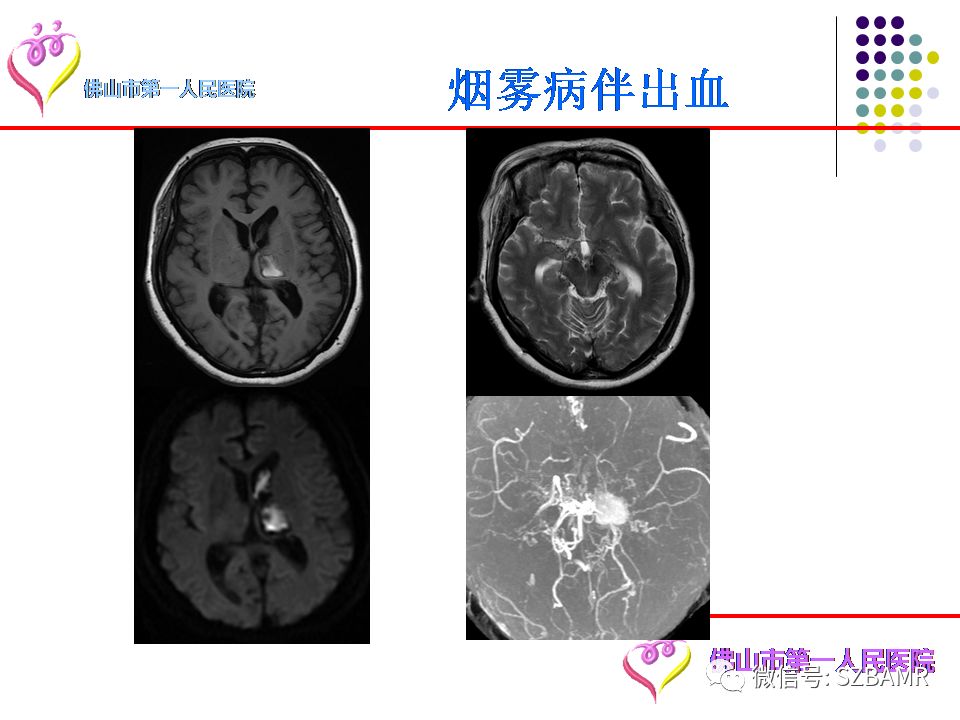 【PPT】脑出血MR表现及病因分析