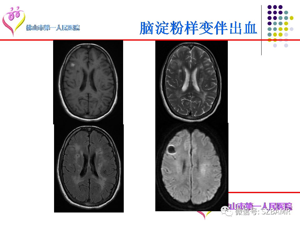 【PPT】脑出血MR表现及病因分析
