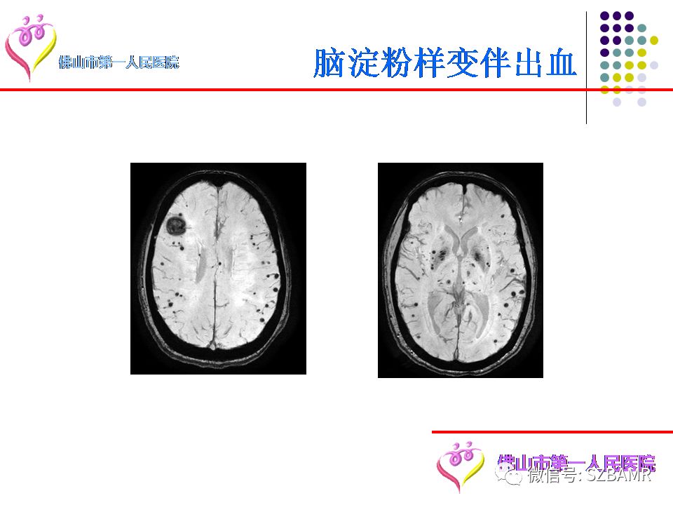 【PPT】脑出血MR表现及病因分析