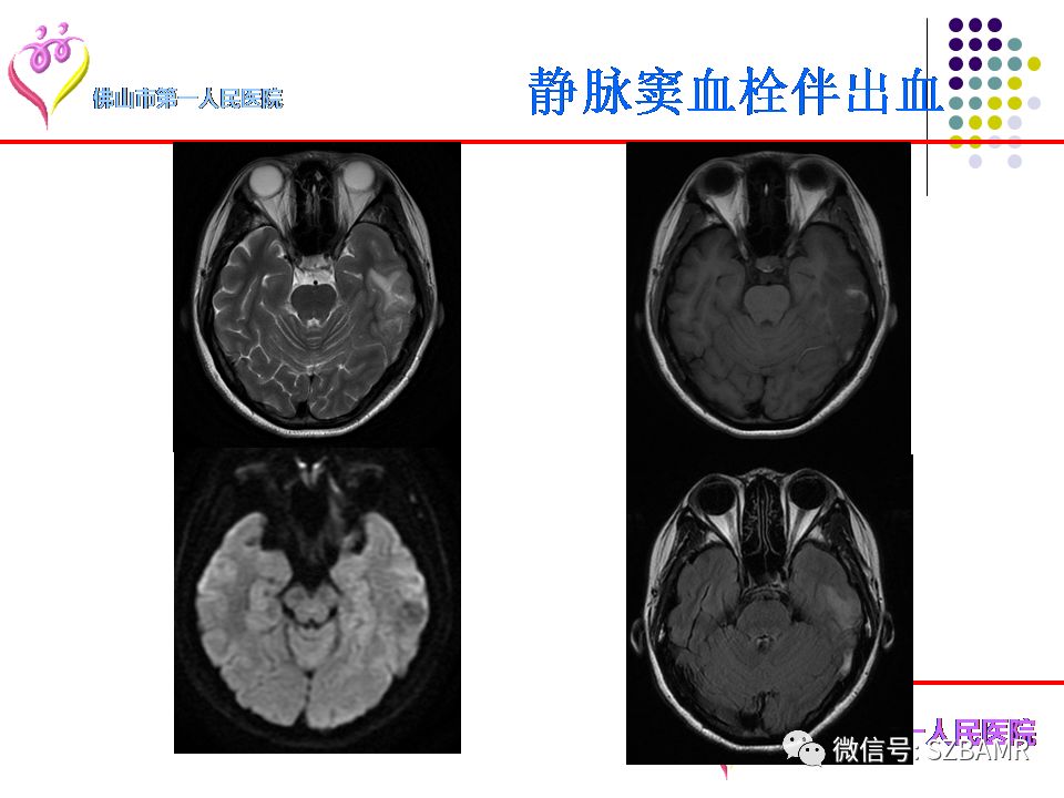【PPT】脑出血MR表现及病因分析