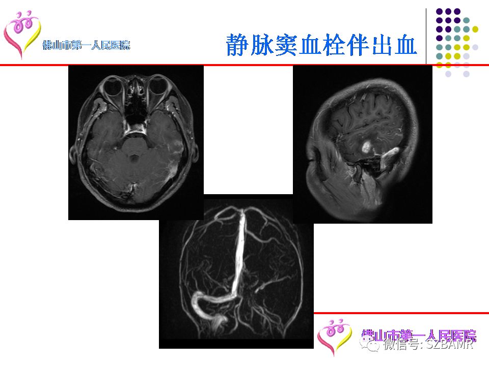 【PPT】脑出血MR表现及病因分析