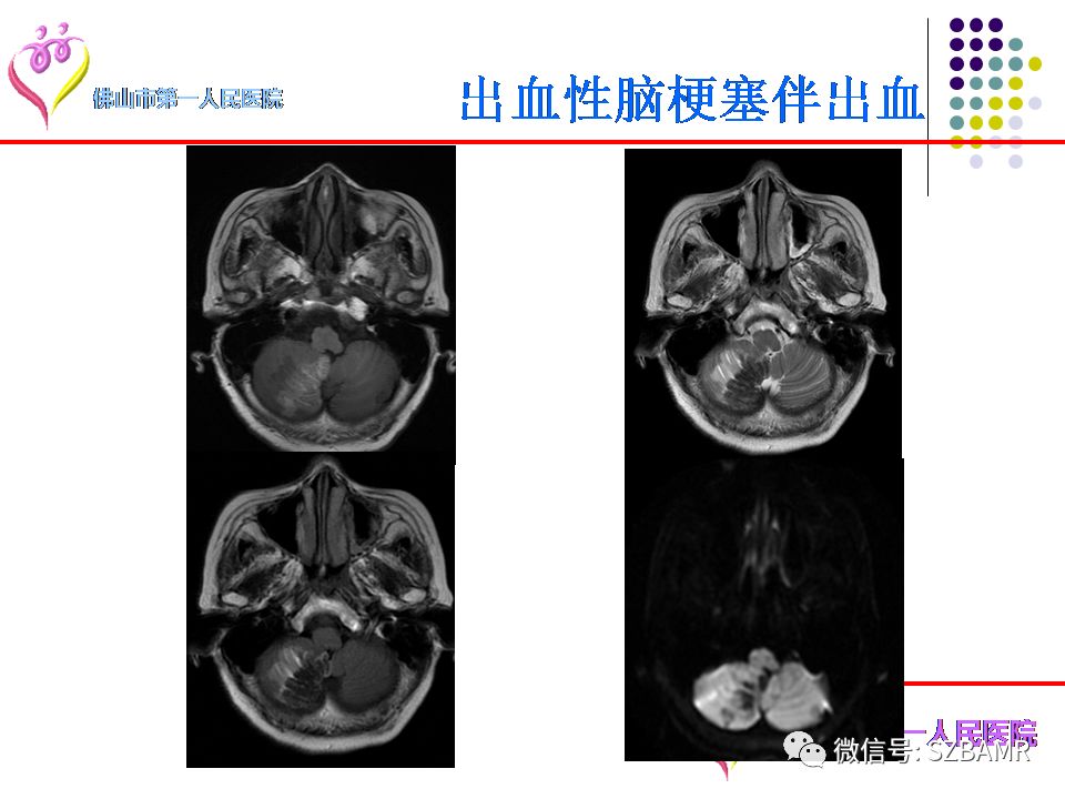 【PPT】脑出血MR表现及病因分析