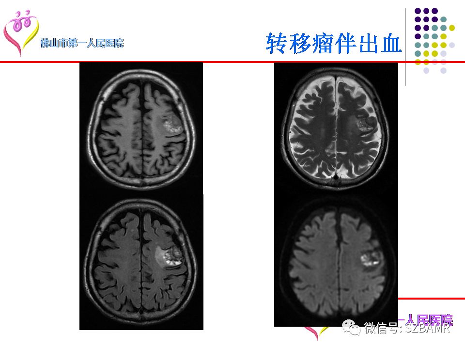 【PPT】脑出血MR表现及病因分析