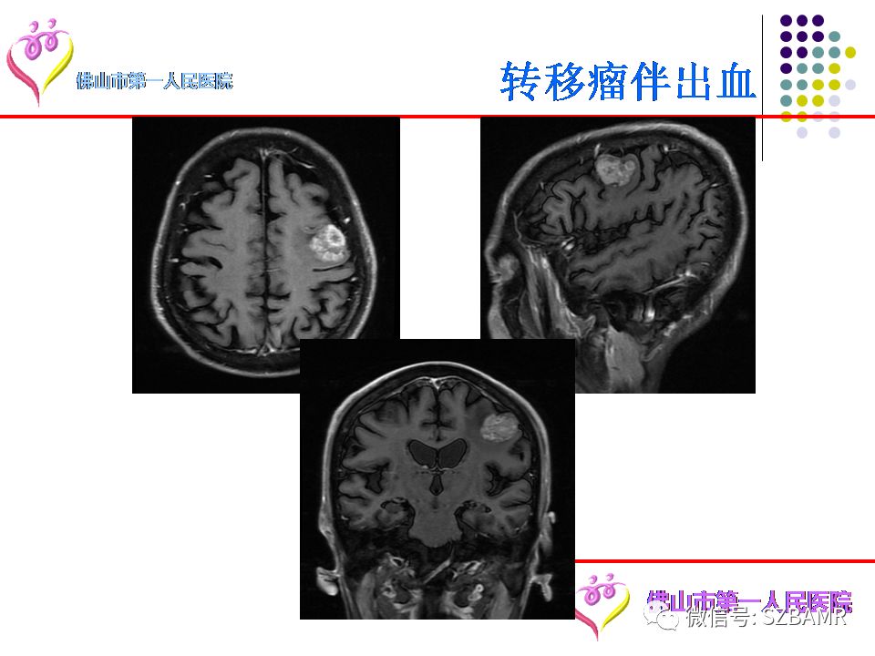【PPT】脑出血MR表现及病因分析