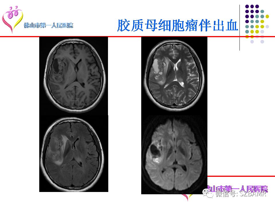 【PPT】脑出血MR表现及病因分析