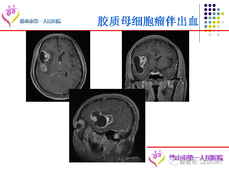 【PPT】脑出血MR表现及病因分析