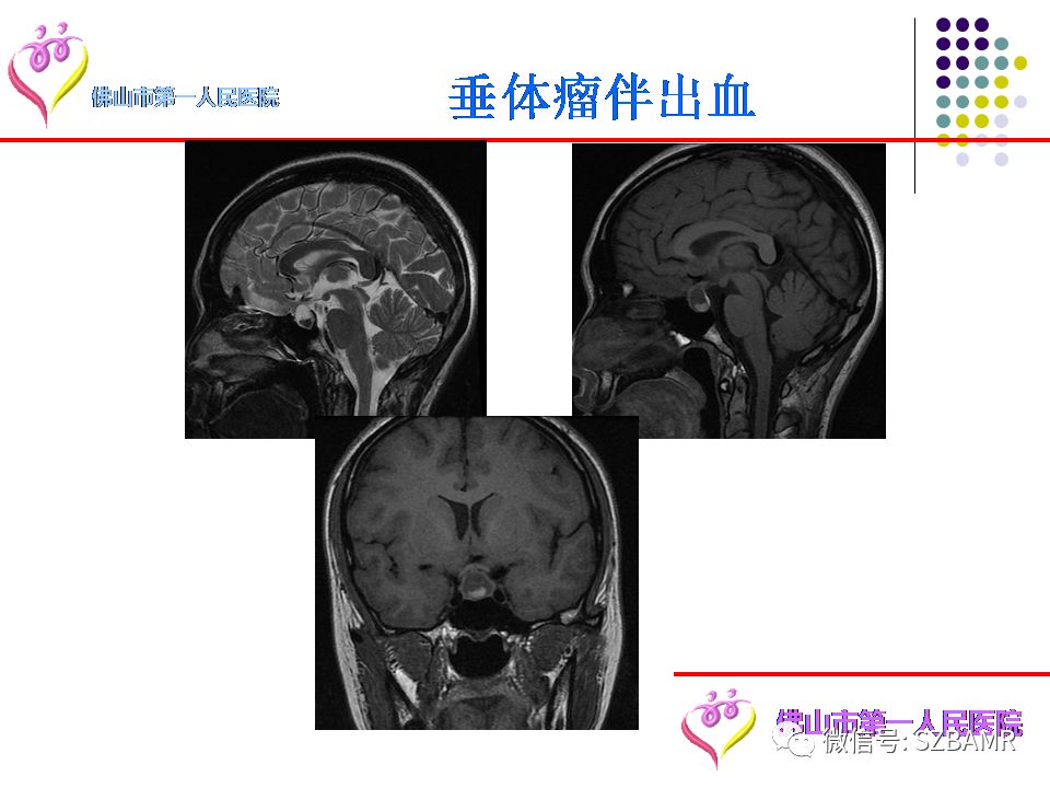 【PPT】脑出血MR表现及病因分析