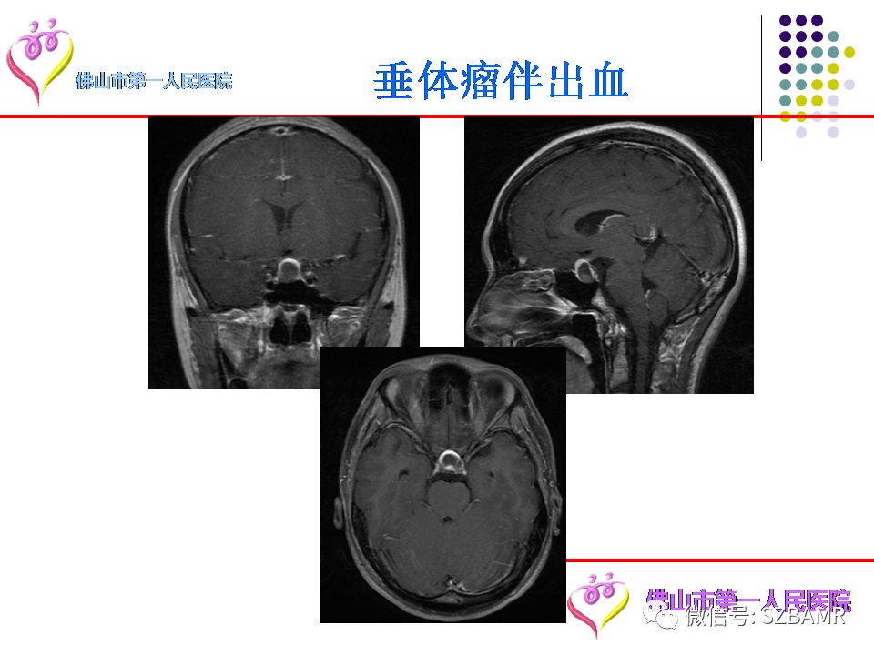 【PPT】脑出血MR表现及病因分析