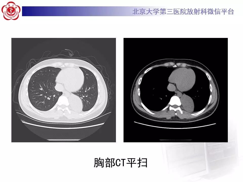 【病例】纵隔节细胞神经瘤1例CT影像表现