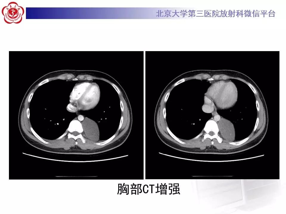 【病例】纵隔节细胞神经瘤1例CT影像表现