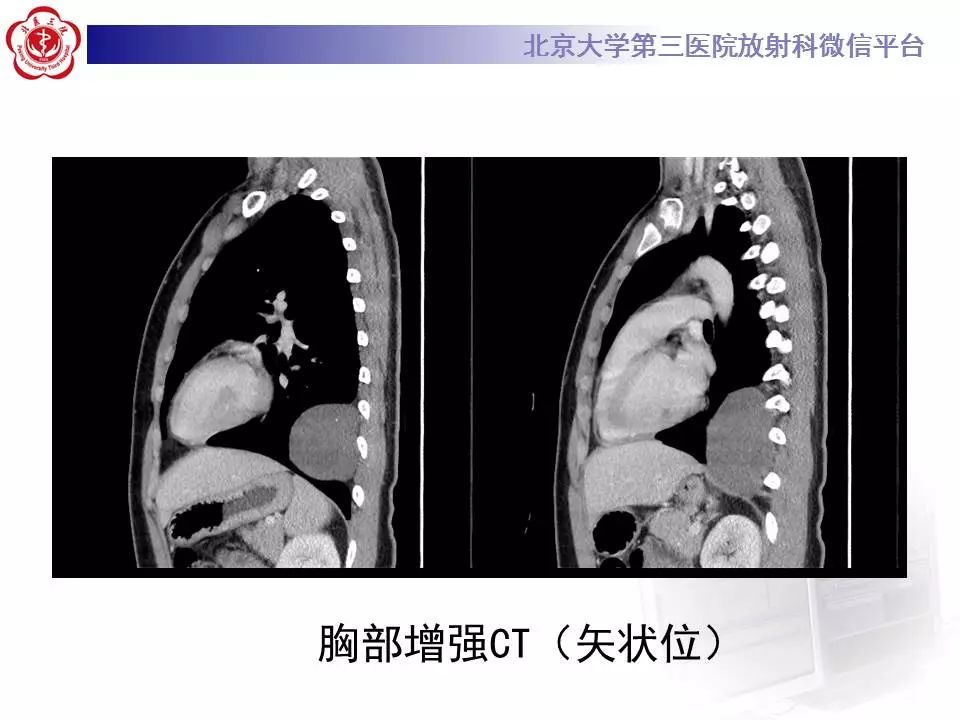 【病例】纵隔节细胞神经瘤1例CT影像表现