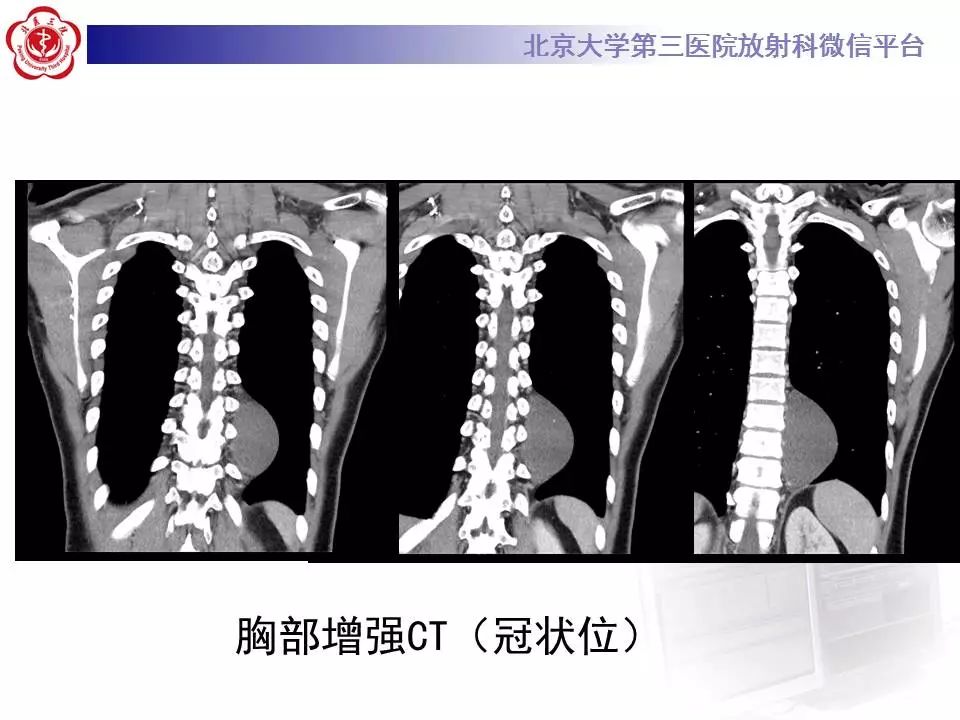 【病例】纵隔节细胞神经瘤1例CT影像表现