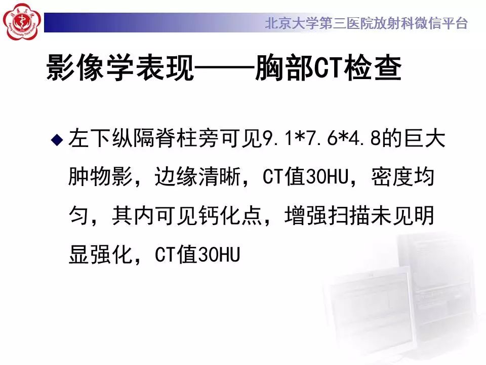 【病例】纵隔节细胞神经瘤1例CT影像表现