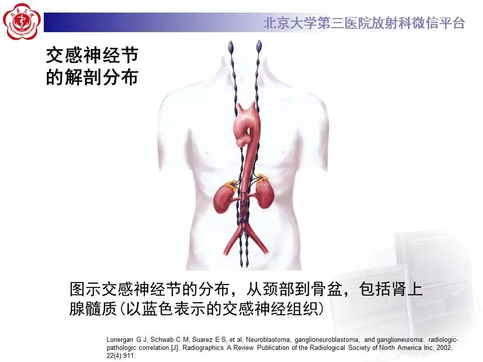 【病例】纵隔节细胞神经瘤1例CT影像表现